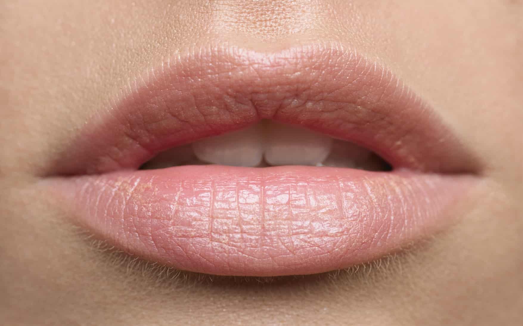 Are dark spots on lips herpes or another type of skin ...